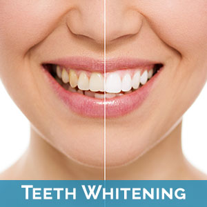 Teeth Whitening in Bayside