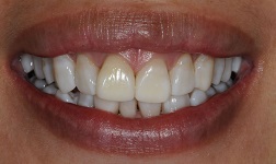 Bayside Before and After Invisalign