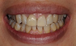 Before and After Dental Implants in Bayside