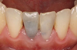 Bayside Before and After Dental Implants
