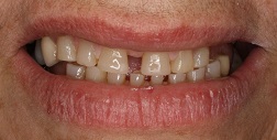 Before and After Dental Fillings in Bayside