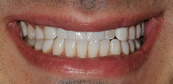 A close-up of a person s smiling mouth, displaying white teeth and pink gums.