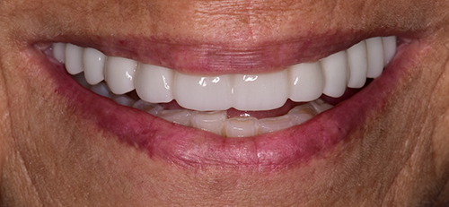 The image shows a person with a wide smile displaying their teeth, set against a neutral background.