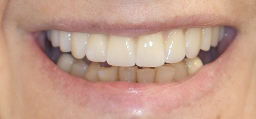 The image shows a close-up of a person s smiling face with teeth and gums visible.