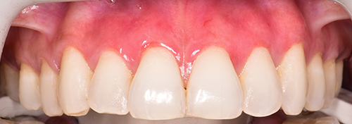 The image shows a close-up view of a person s mouth with teeth, some of which are discolored with pink stains, against a neutral background.