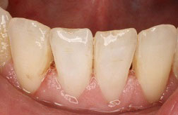 The image shows a close-up view of a person s mouth with visible dental work, including teeth with fillings and possibly veneers, set against a background that appears to be a medical or dental office environment.