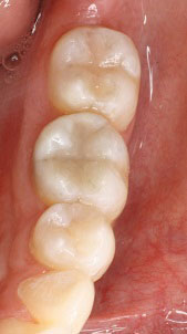 The image displays a close-up view of a person s mouth with teeth showing, which includes a set of dentures with visible wear and tear.