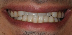 A close-up image of a person with a wide smile showing teeth, capturing the lower half of their face.