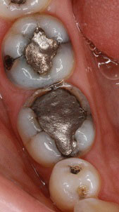 A close-up view of a mouth with an upper tooth that has been damaged, revealing a silver filling inside.