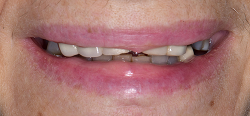 The image shows a close-up of an individual s smile with teeth showing, including a partial denture on the lower front teeth.