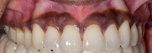 The image displays a close-up view of a person s teeth with a focus on an upper front tooth that appears to be damaged, possibly due to decay or injury, with a visible hole and discoloration.