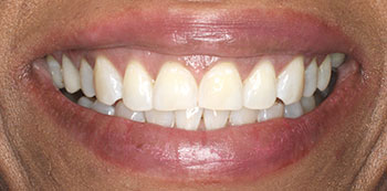 A person s smiling face with a focus on their teeth and lips, set against a neutral background.