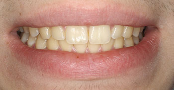The image shows a close-up view of a person s lower face with a focus on their teeth, which appear to be well-maintained and white, set against a neutral background.