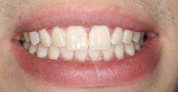 The image shows a close-up of a person s teeth with an open mouth, revealing a smile with white dental implants, set against a neutral background.