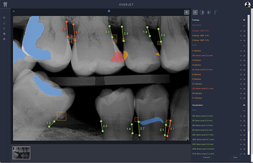 An X-ray image displayed on a computer screen with annotations indicating measurements and areas of interest.