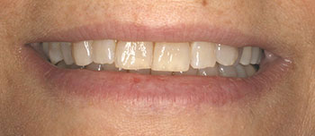 The image shows a close-up view of a person s smiling face with a focus on their teeth and mouth area, set against a neutral background.