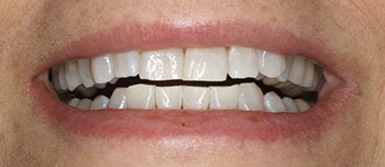 The image shows a close-up of a person s mouth with teeth that are visibly crooked and uneven, likely for dental implant advertisement purposes.