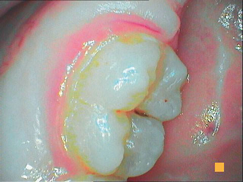 The image shows a close-up view of a person s mouth with a large cavity filled with yellowish substance, revealing damaged tooth enamel and possibly decaying teeth.